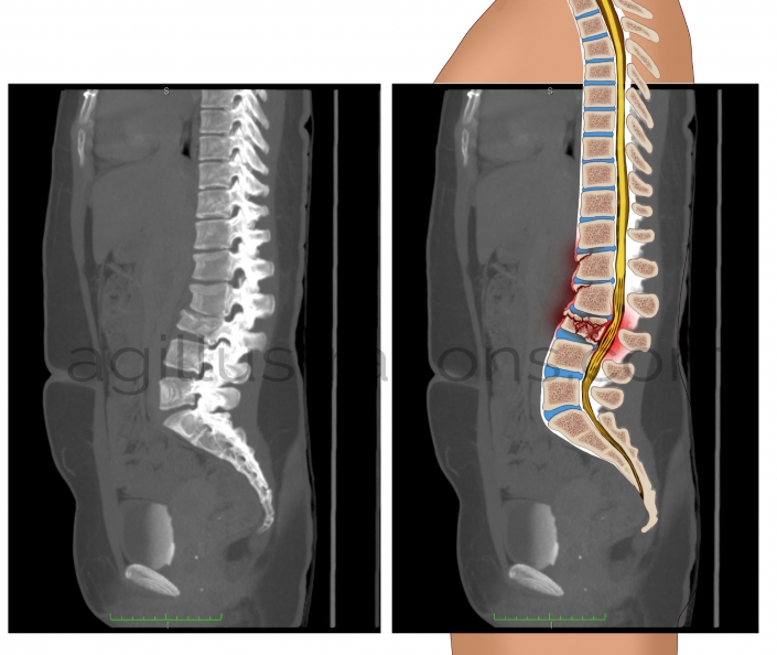Case Study Spine